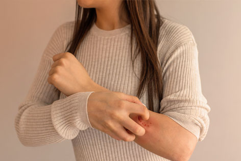 psoriasis